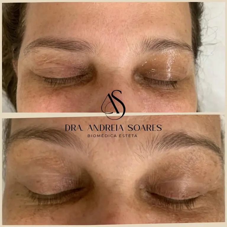 Limpeza de pele/ Rejuvenescimento facial/ blefaroplastia de pálpebras/ botox